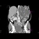Abdominal sacroma: CT - Computed tomography